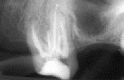 Dental Implant - 