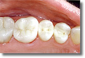 Dental Implant - 