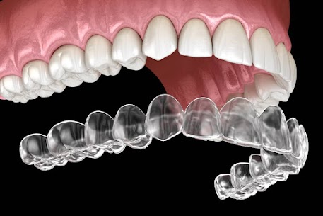 Santa Monica Invisalign Clear Aligners