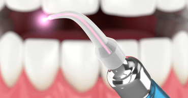 Patient treating gums with laser Dentist in Sydney, Periodontic, Sirolaser, Laser dentistry, glebe, sydney CBD, dentist, same-day dental surgery by cosmetic dentist at the dental clinic.