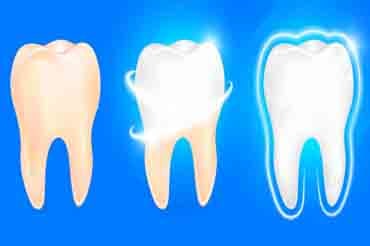 Sydney dentist teeth restoration image