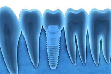 Single Implant image