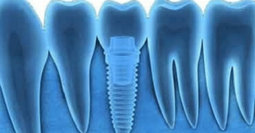 Image shows how a tooth is implanted into using pain-free dentistry techniques