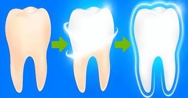 Restoration dentist work with dental filling for tooth decay, root canal therapy, crowns, bridges and veneers that promotes a good dental health.
