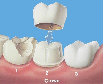Dental crown
