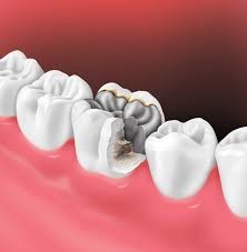 What is a Dental crown
