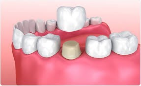 dental crown