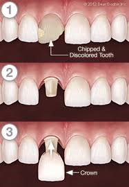 dental crown