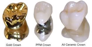What is a Dental crown