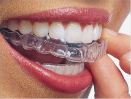 woman showing how easy is to wear or remove the clear braces out of the teeth