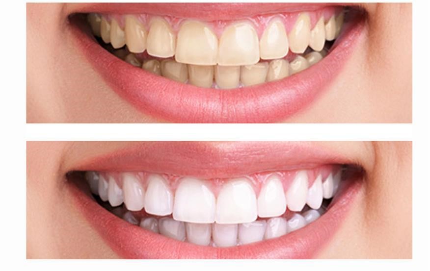 teeth whitening before and after