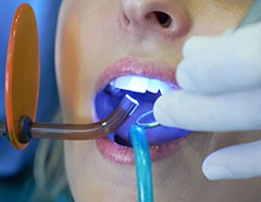 teeth whitening
