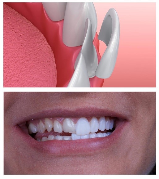 Veneers