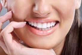 Veneers