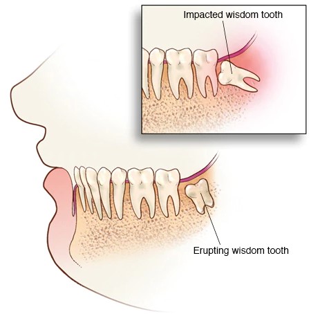 Wisdom Teeth