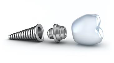 Dental Implant | Garden City Dentist