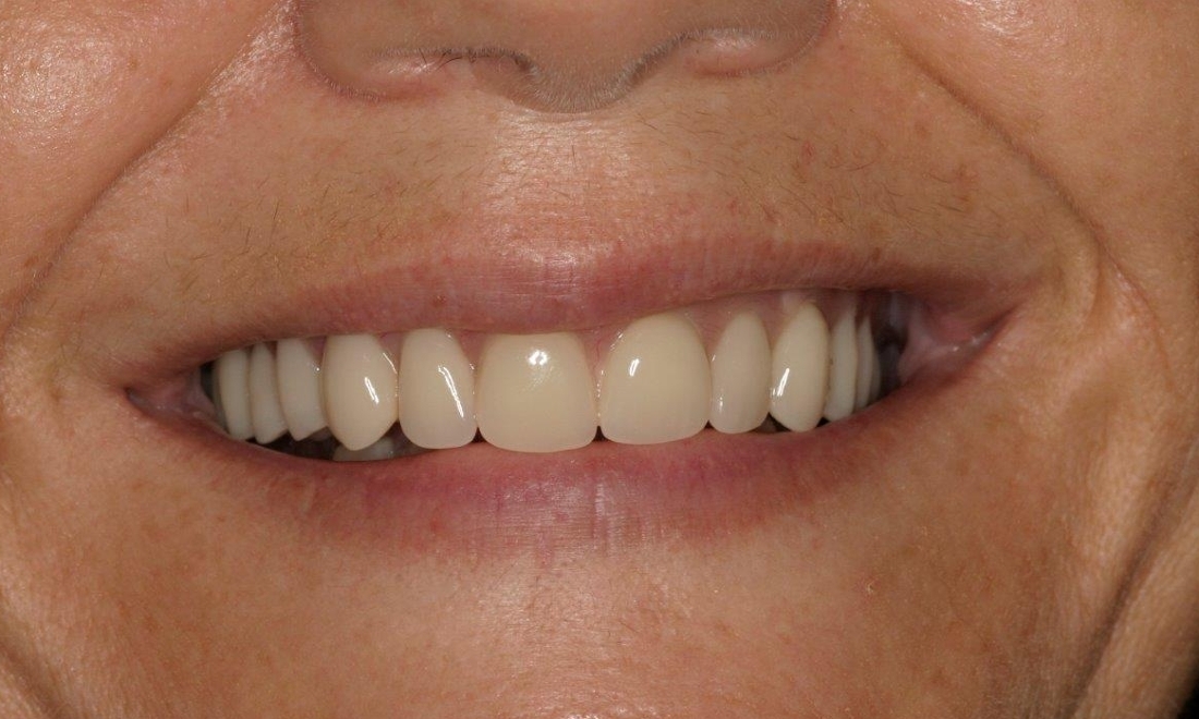 Patient after reconstruction | Booragoon WA