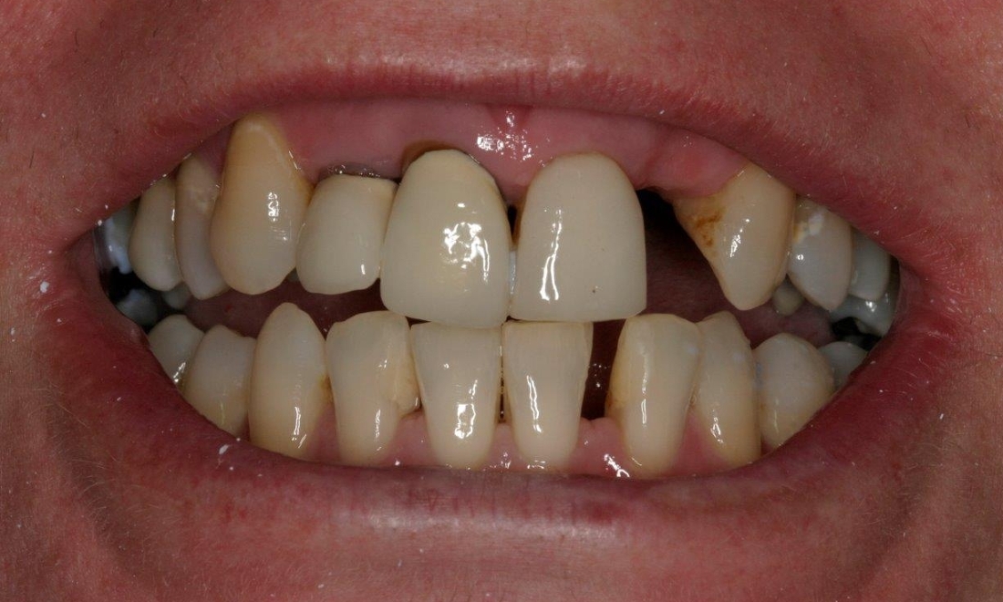 Full Mouth Reconstruction Before & After | Alfred Cove