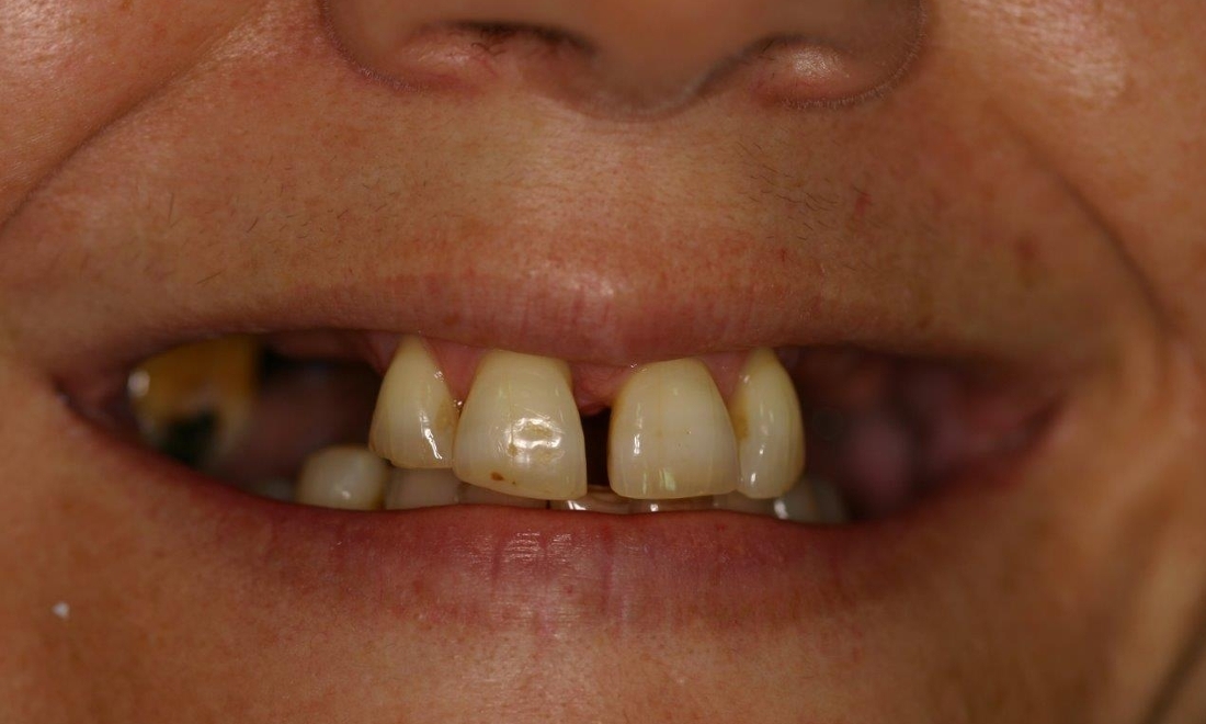 Patient needing dental imlants | Booragoon WA