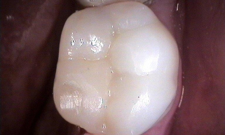 Porcelain-Fillings-Restoration-After-Image