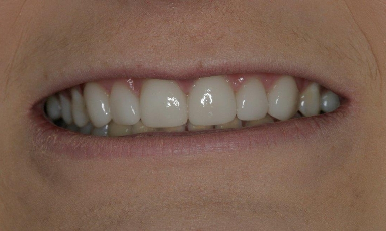 Porcelain-Veneers-After-Image