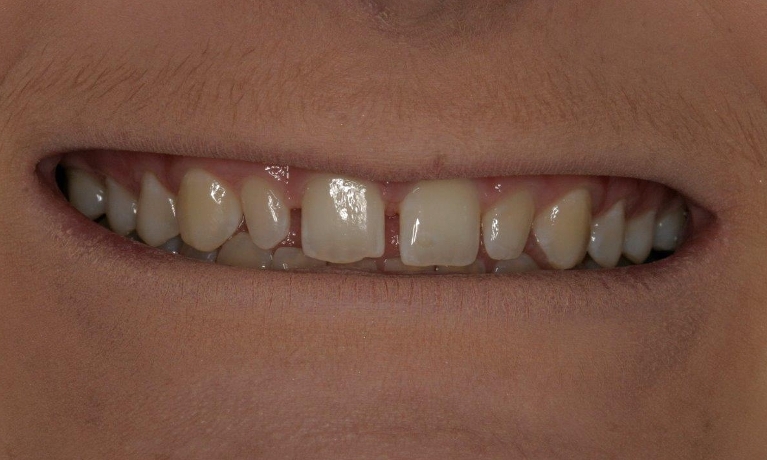 Porcelain-Veneers-Before-Image