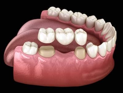 Model of a dental bridge in Santa Monica Dentist