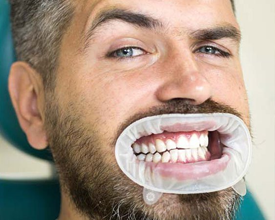 After Teeth Whitening