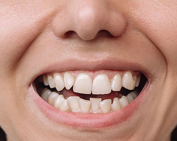 Before Teeth Straightening