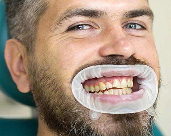 Before Teeth Whitening